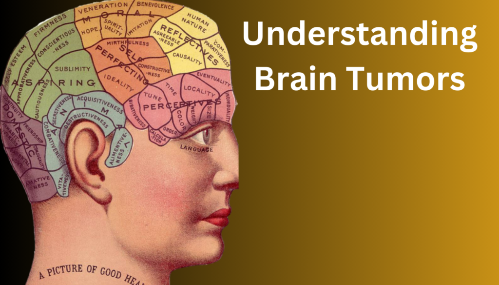 Brain Tumors: A Comprehensive Guide