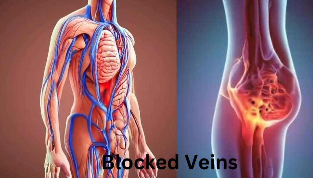 Recognizing Symptoms of Blocked Veins: A Guide to Understanding and Seeking Help